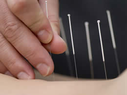 Acupuncture stress